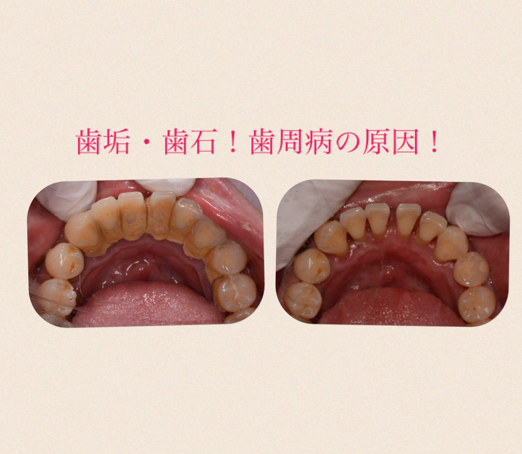 歯石がいっぱい。 | 歯医者さんのオススメ治療
