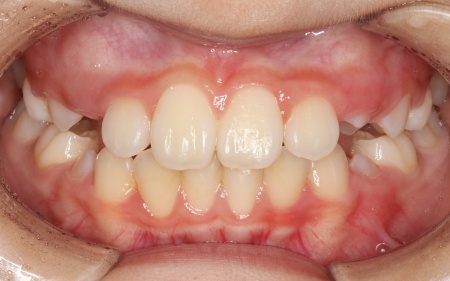 10歳女の子 顎の幅を広げる装置とマウスピース型の矯正装置で反対咬合を改善した症例