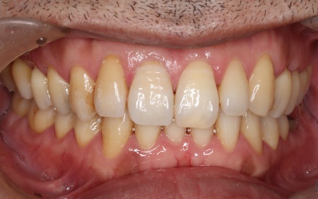 40代男性 折れた前歯をジルコニアとポーセレンを組み合わせた被せ物で修復した症例
